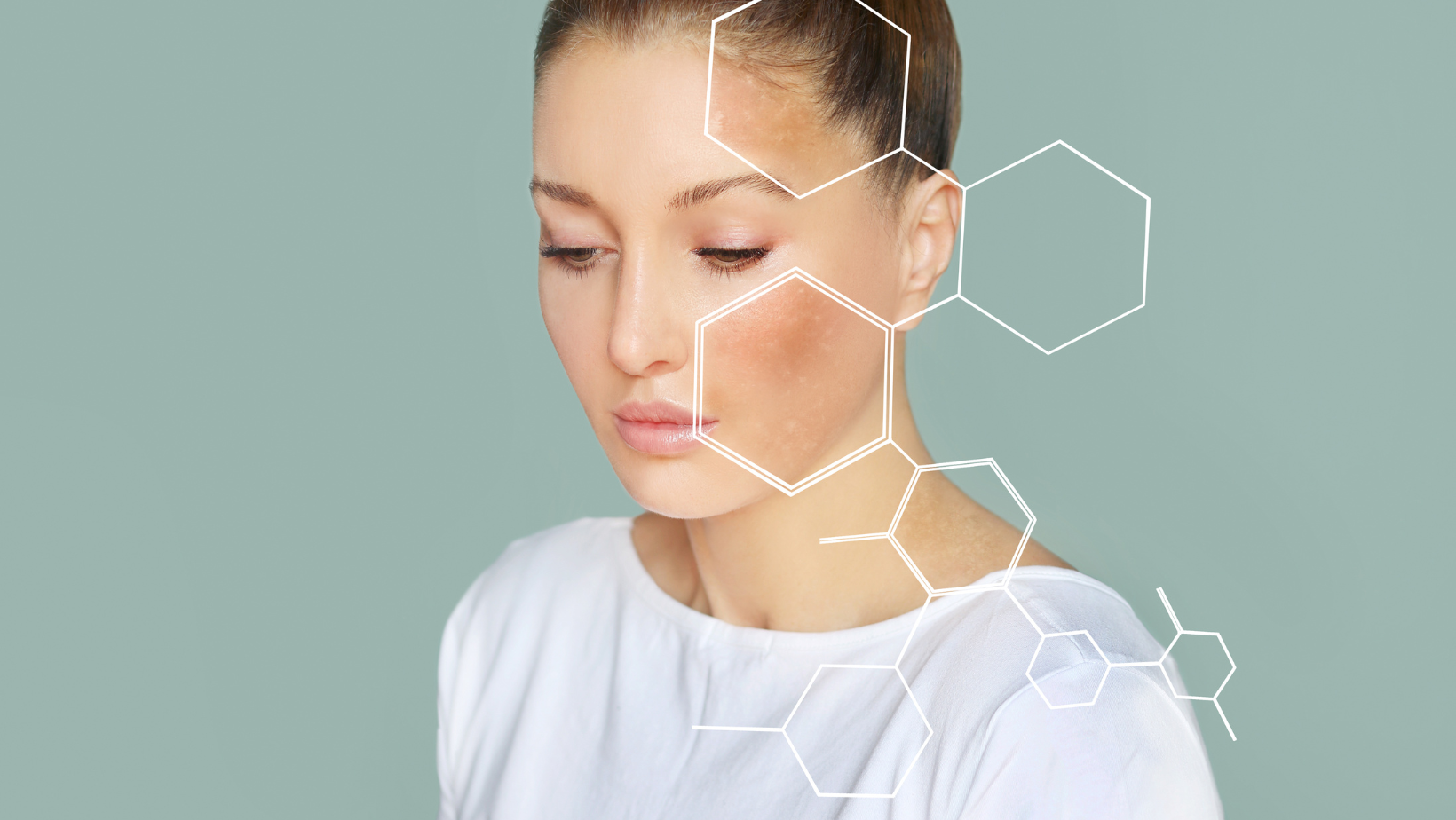 IPL Treatment for Sun Damage and Pigmentation at Nix and Tee